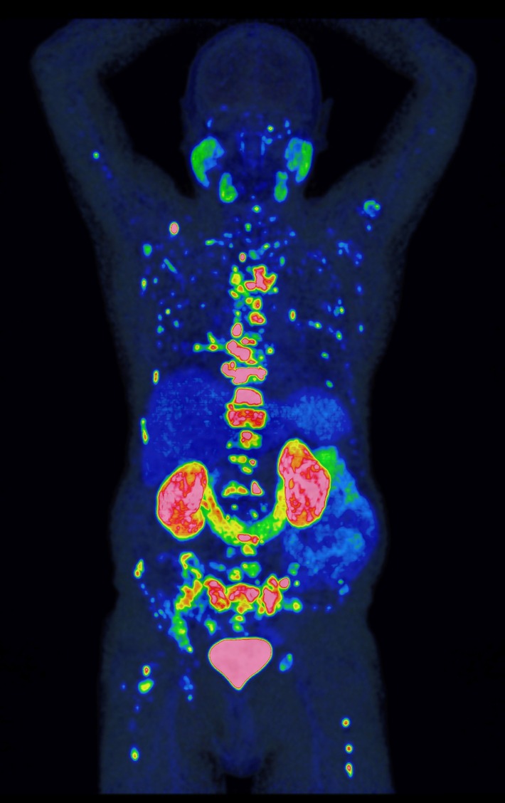 Neue Methode verbessert Prognose und Therapie von Prostatakrebs