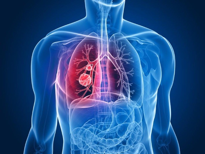 Neue Option für Lungenkrebspatient:innen: Innovative Therapie mit elektrischen Wechsel-feldern jetzt CE-zertifiziert

Eine neue Behandlungsoption für die Therapie des metastasierten Lungenkrebses: Die soge-nannte Tumor Treating Fields-Therapie (TTFields-Therapie), bei der elektrische Wechselfelder in einem Frequenzbereich von 100 kHz bis 500 kHz gezielt gegen Tumorzellen eingesetzt werden, hat eine neue CE-Kennzeichnung erhalten. Sie darf ab sofort auch bei Erwachsenen mit metastasiertem nicht-kleinzelligem Lungenkarzinom (mNSCLC) angewendet werden, die während oder nach einem platinbasierten Behandlungsregime einen Progress erlitten haben - begleitend mit Immun-Checkpoint-Inhibitoren oder dem Chemotherapeutikum Docetaxel. / Weiterer Text über ots und www.presseportal.de/nr/137725 / Die Verwendung dieses Bildes für redaktionelle Zwecke ist unter Beachtung aller mitgeteilten Nutzungsbedingungen zulässig und dann auch honorarfrei. Veröffentlichung ausschließlich mit Bildrechte-Hinweis.
