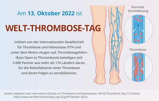 Fachpressemitteilung: Welt-Thrombose-Tag – Jede vierte Todesursache jährlich wird durch eine venöse oder arterielle Thrombose bedingt