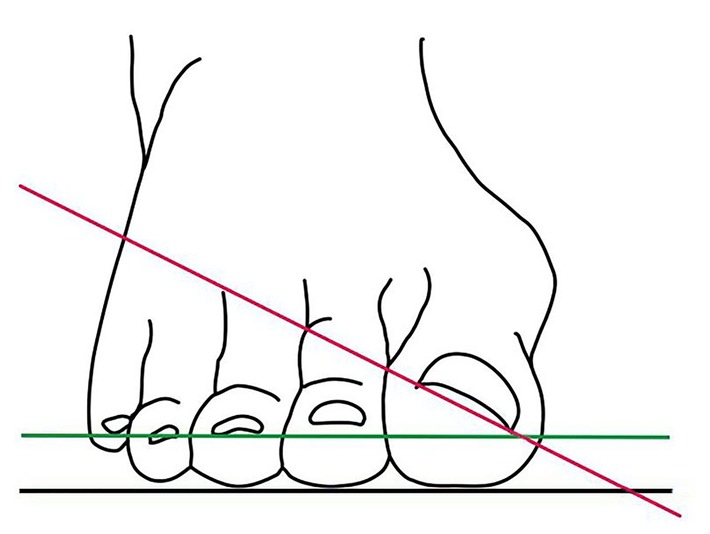 "Hallux valgus" -  Das schmerzhafte Problem mit dem großen Zeh