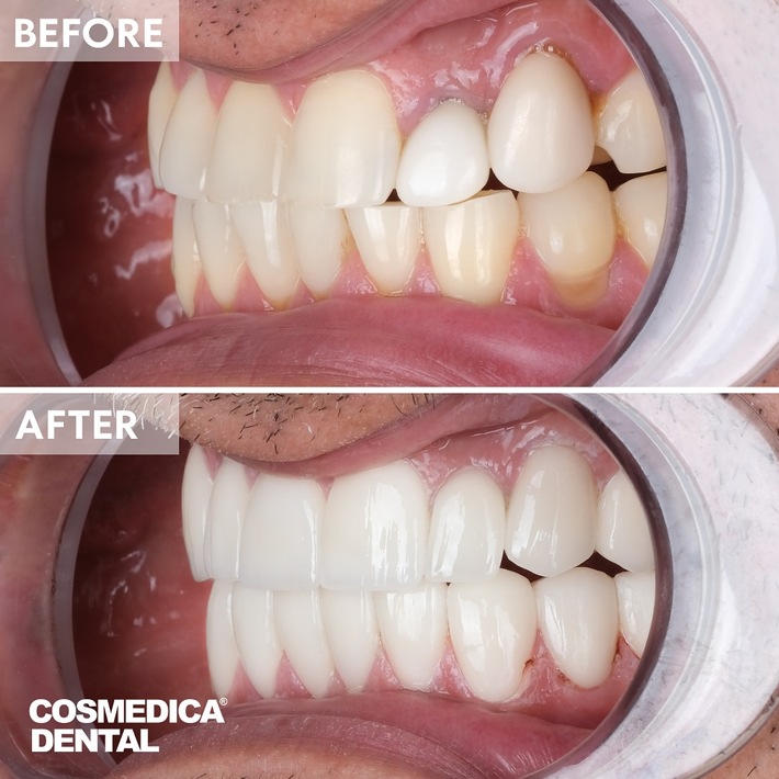 Zahnaufhellung Türkei: Professionelle und schnelle Behandlung bei Cosmedica Dental