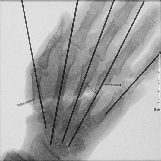 Abgetrennte Hand Röntgenbild 2.JPG