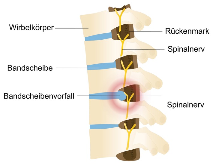 Bandscheibenvorfall? Kaputte Stoßdämpfer!