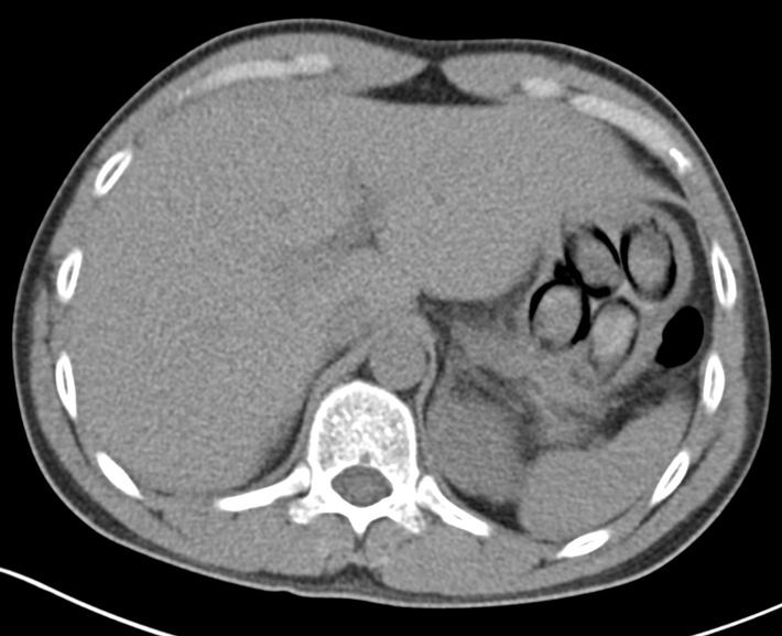 HZA-K: Mit Kokain im Bauch auf Reisen / Kölner ZOLL stellt niederländischen Körperschmuggler im Bus