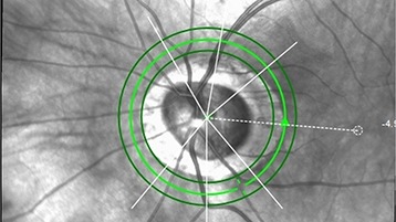 Grüner Star: Neues Verfahren zur Früherkennung. TH Köln entwickelt kostengünstiges Glaukom-Diagnosegerät