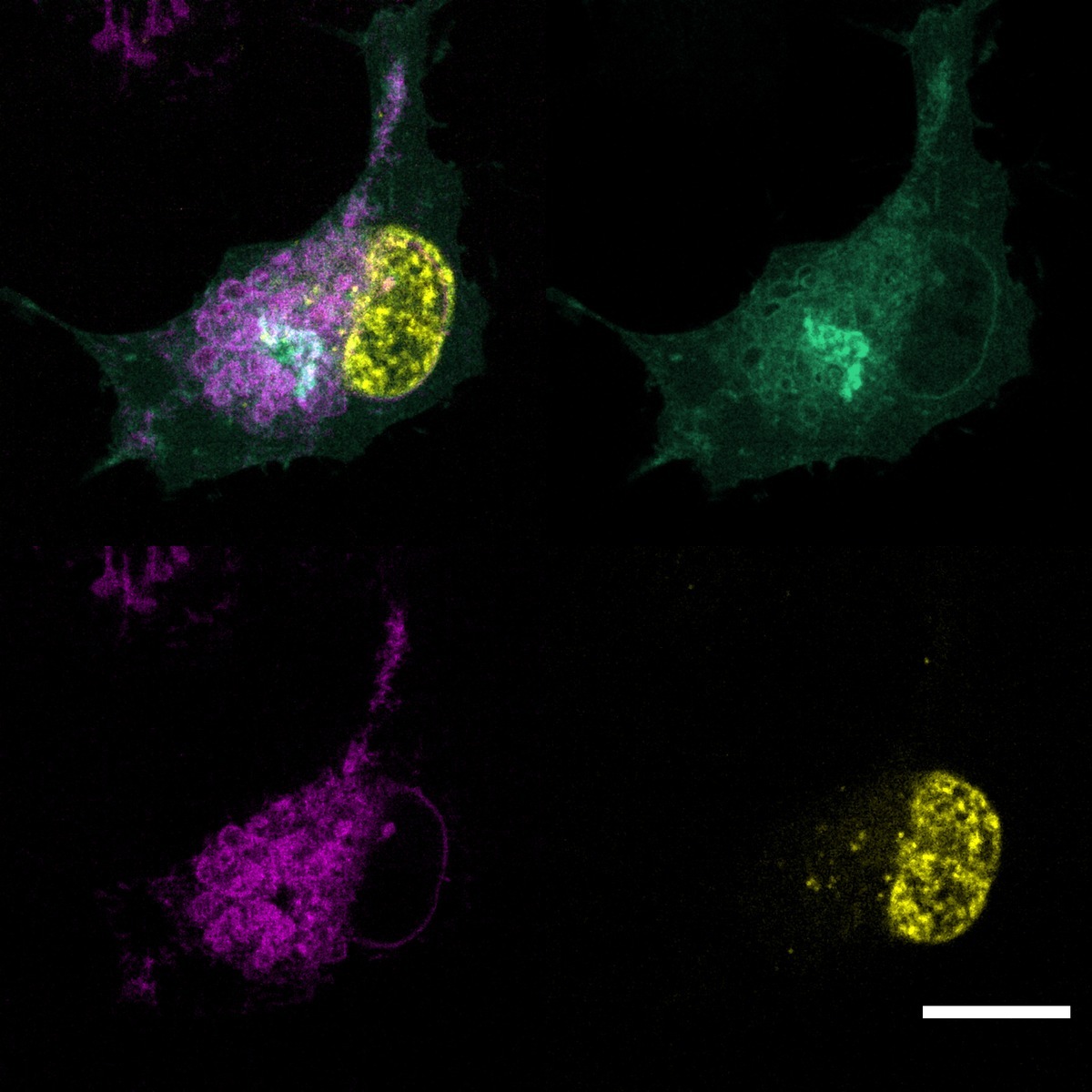 Identifizierung eines Ferroptose-Suppressor-Proteins ermöglicht einen neuen Ansatz zur Behandlung von Krebs