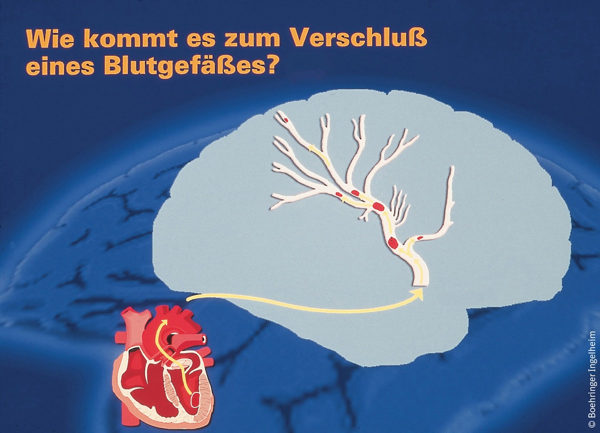 Ein Schlaganfall kommt selten allein / Neue Perspektiven der Boehringer Ingelheim-Forschung zur Verhinderung von Schlaganfällen