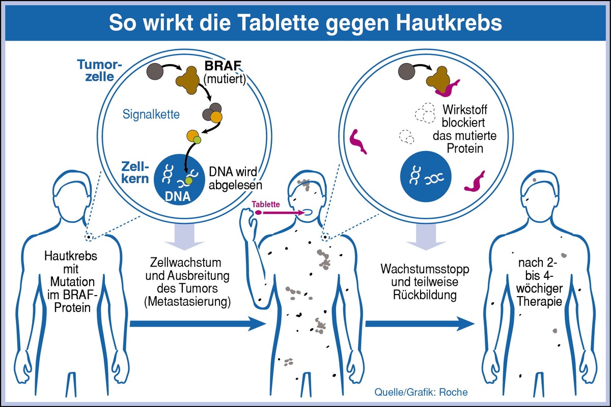 Seit Anfang 2012 ist ein sogenannter Signal-Blocker zur Therapie des metastasierten schwarzen Hautkrebses zugelassen (BILD)