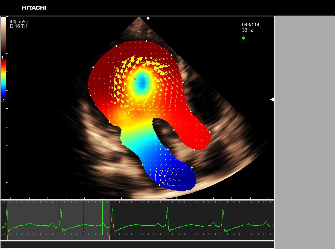 Hitachi Medical Systems Europe introduces the third generation of non-invasive intracardiac blood flow visualization technology, at EuroEcho Imaging 2018