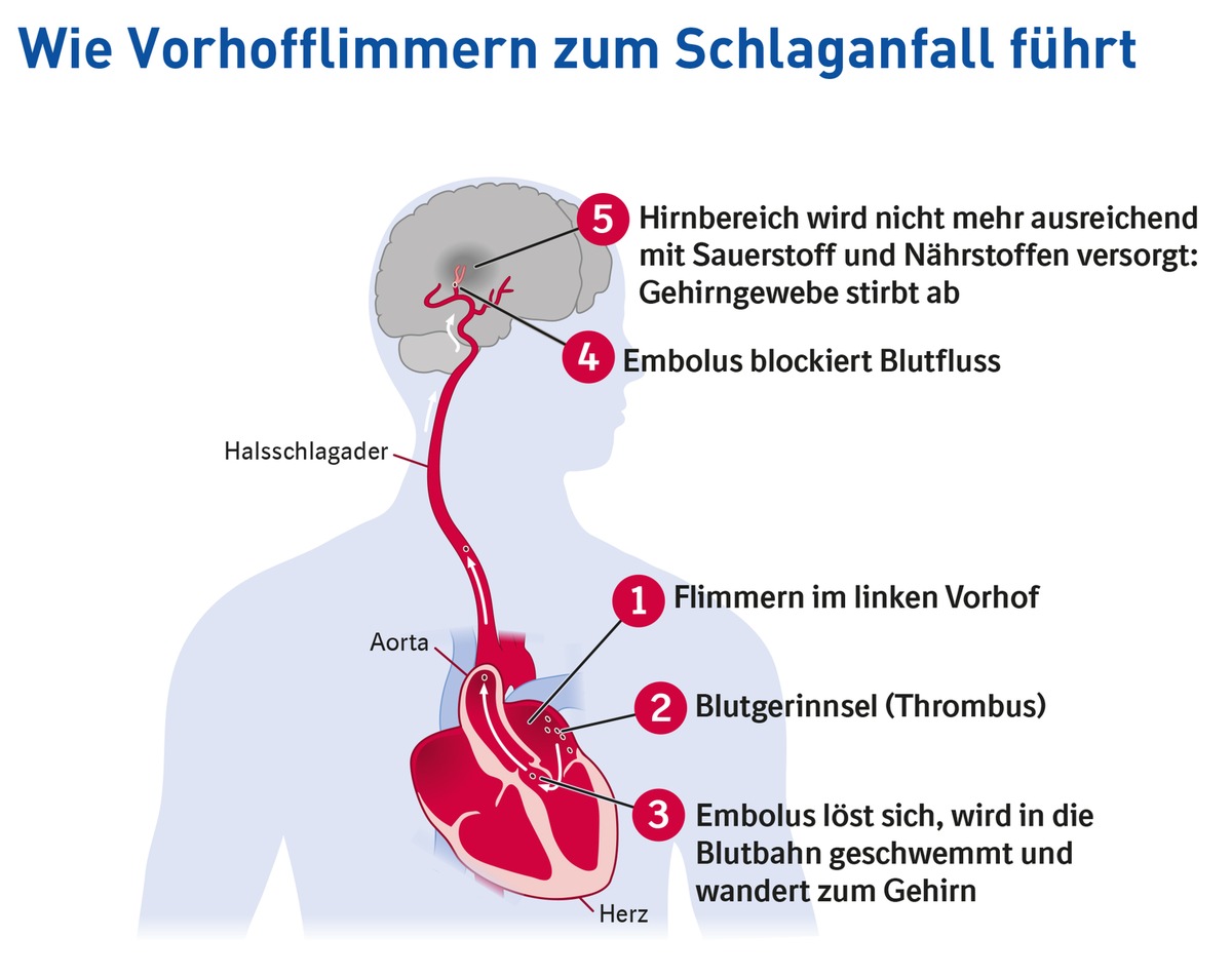 Weltschlaganfalltag am 29. Oktober: Vorhofflimmern - möglicher Vorbote eines Schlaganfalls (FOTO)