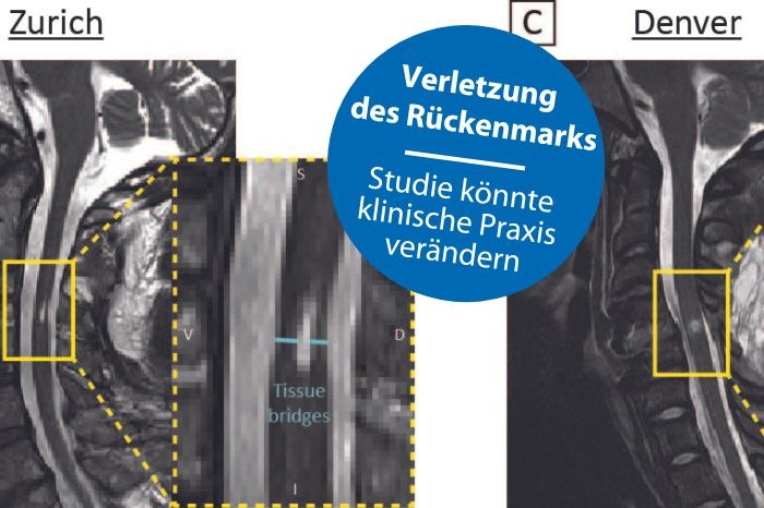 MEDIENMITTEILUNG / PRESS RELEASE – Halswirbelsäulenverletzung: Studie hat das Potenzial, die klinische Praxis zu verändern / Cervical spine injuries: Study has the potential to change clinical practice