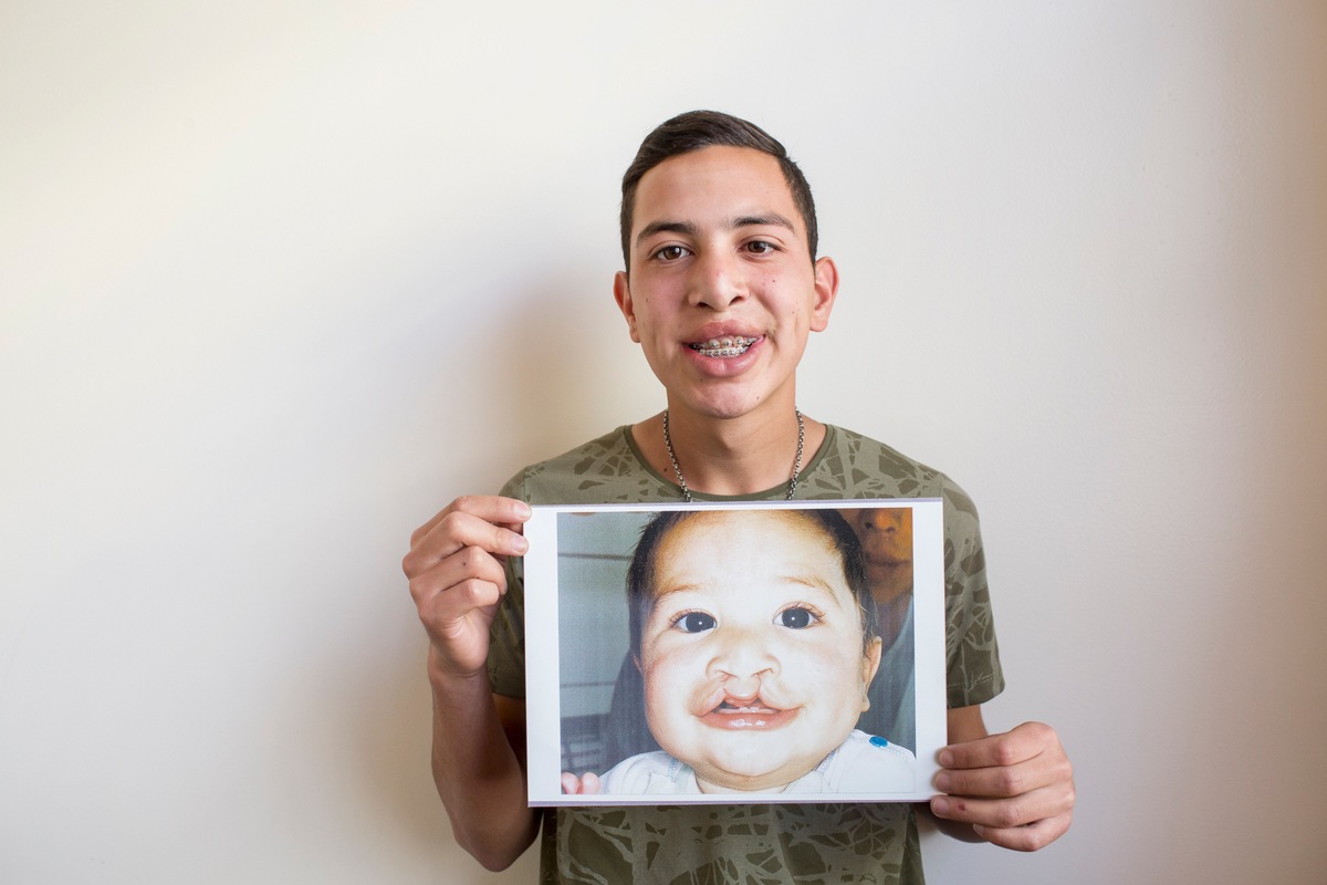 FDI World Dental Federation and Smile Train launch project to improve oral health of children with clefts: the most common birth difference of the face and mouth