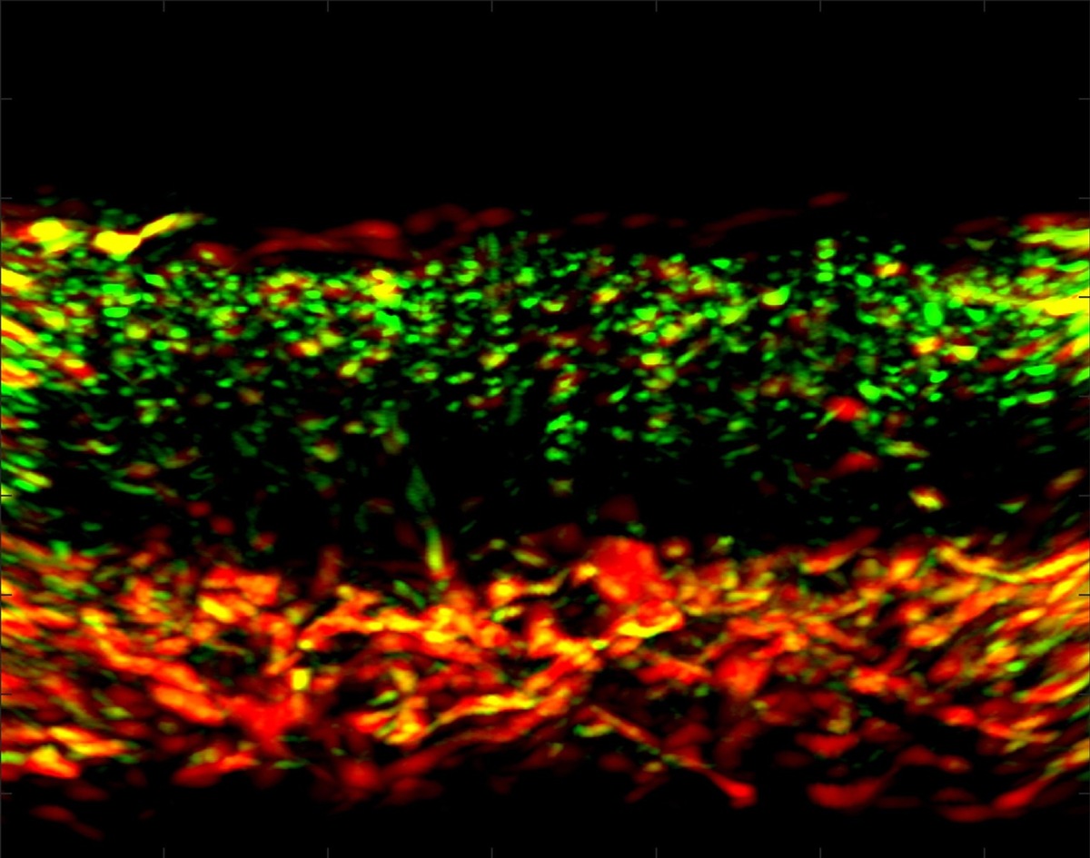 Unter die Haut: Bessere Behandlung von Schuppenflechte mit neuer Scanner-Technologie