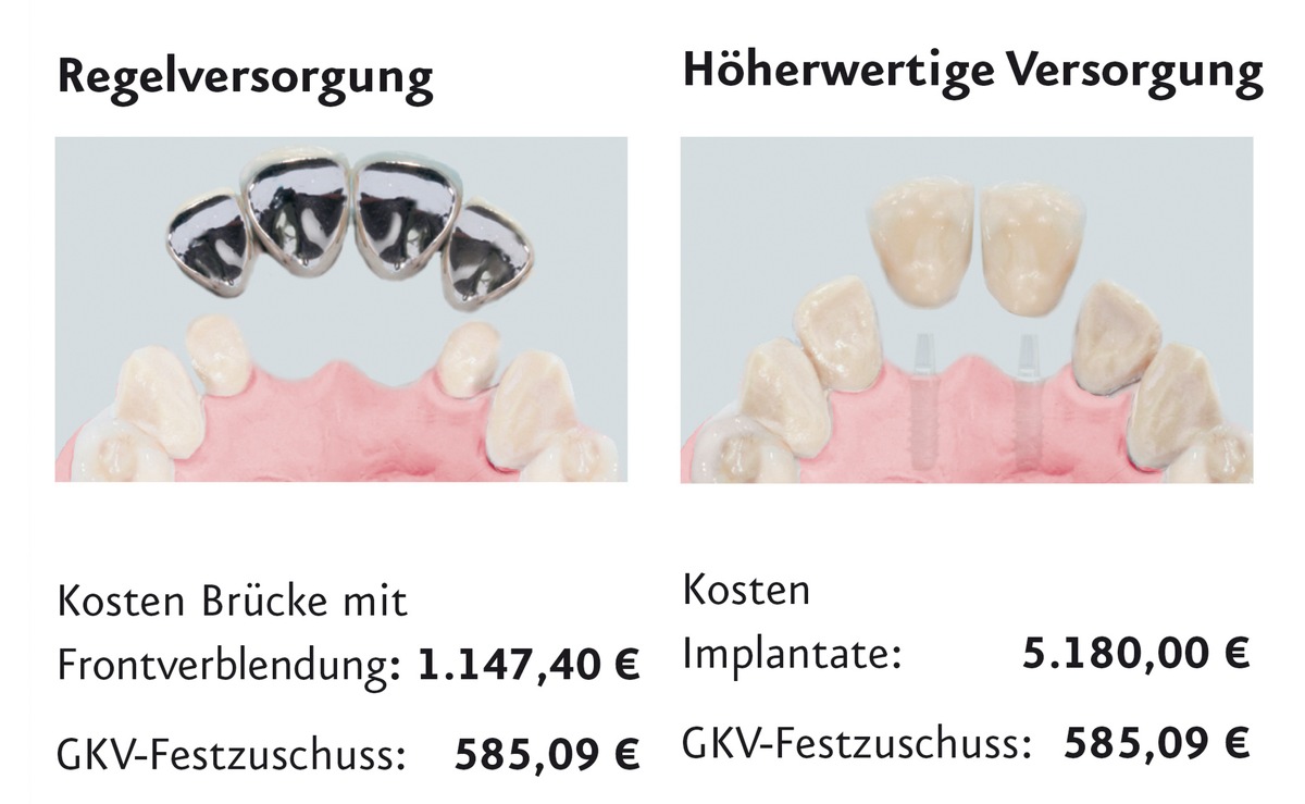 Vorsorge ist besser als Nachsorge: Wie sinnvoll ist eine Zahnzusatzversicherung?