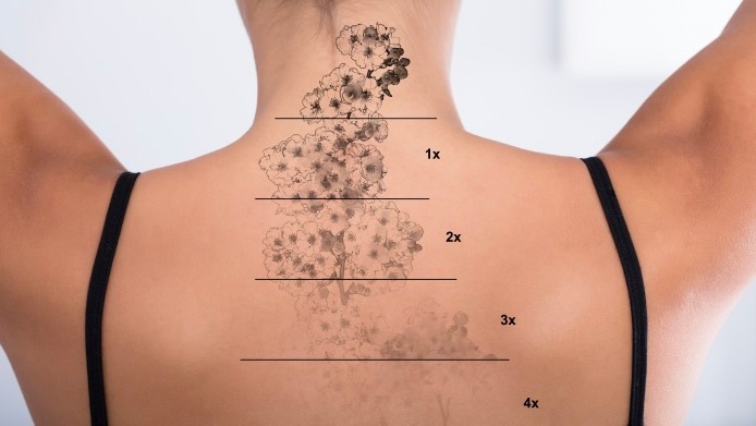 Dermatologie Quist: Tattooentfernung mit dem Picosekundenlaser – alles über Vorteile, Risiken und Vorgang