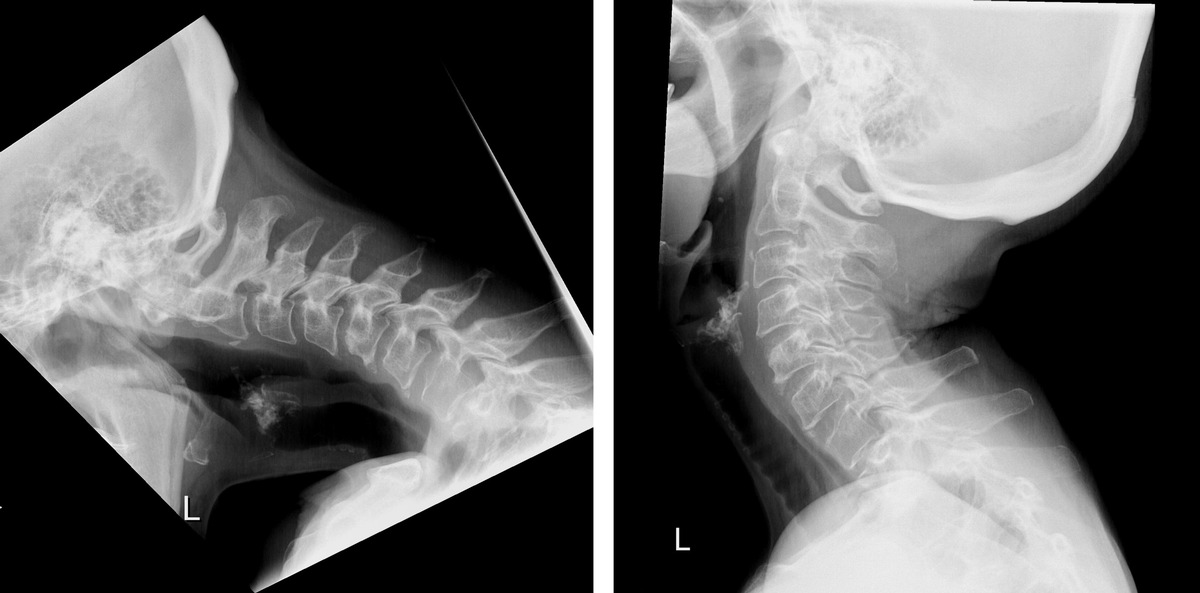 MEDIENMITTEILUNG / PRESS RELEASE: Neuartige Operation zur Behandlung von Dropped Head Syndrom / Innovative surgery for the treatment of dropped head syndrome