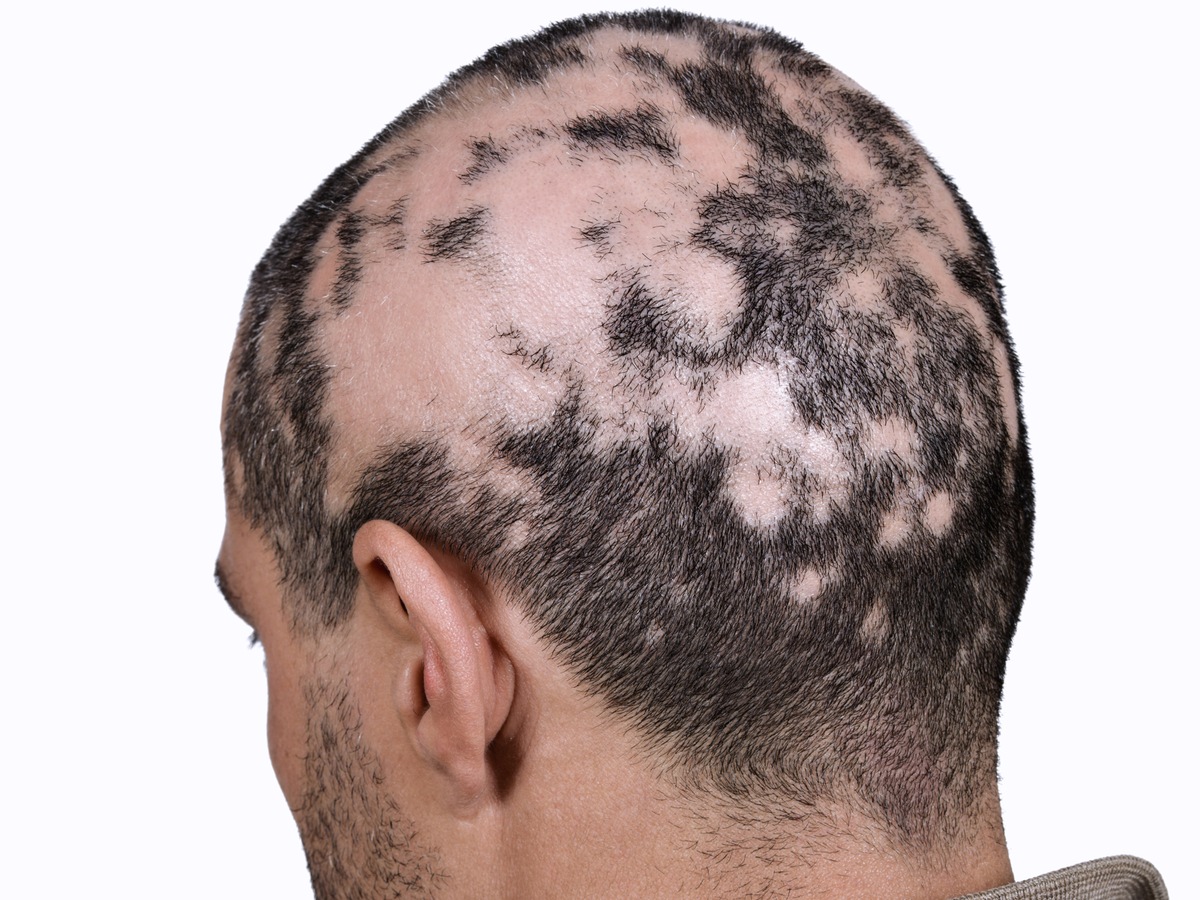 Mehr als ein ästhetisches Problem: Kreisrunder Haarausfall in schweren Formen behandlungsbedürftig / Tag der Immunologie 2023: Alopecia areata &quot;verkannte&quot; Autoimmunerkrankung?