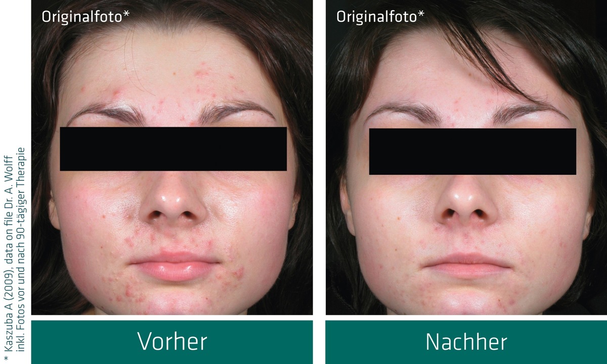 Erstmalig - Aknecreme als Medizinprodukt in der Drogerie und Apotheke / Doppelblind-Studie belegt Wirkung (mit Bild)