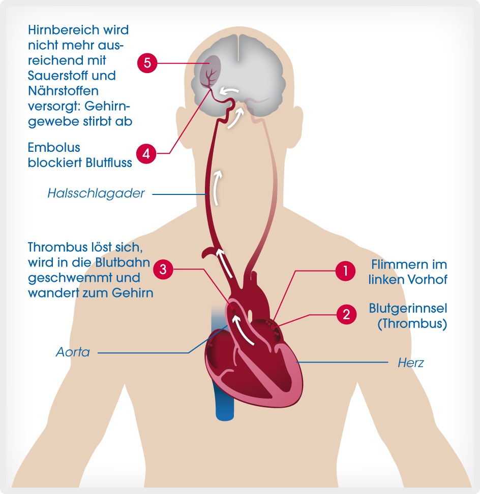 Neun von zehn befragten Patienten mit Vorhofflimmern sorgen sich um ihr Schlaganfallrisiko und wollen in Therapieentscheidungen einbezogen werden (FOTO)