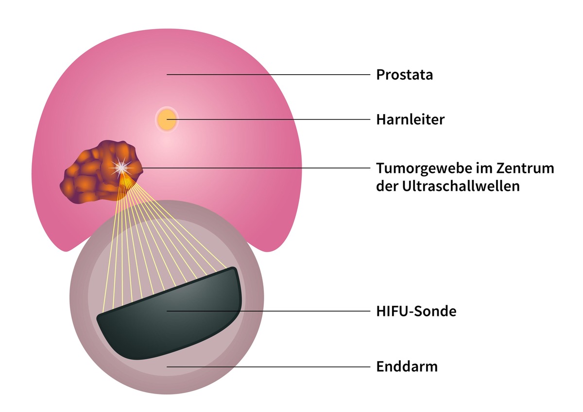 Weniger ist oft mehr: Zu viele Prostata-Krebspatienten leiden unter einer Übertherapie / Neue Studie belegt die Nachteile von Skalpell und Bestrahlung