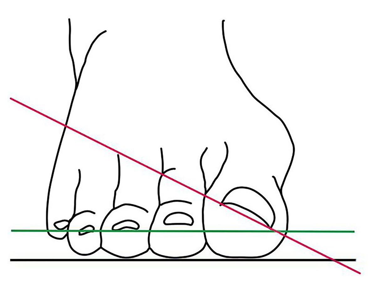 &quot;Hallux valgus&quot; -  Das schmerzhafte Problem mit dem großen Zeh