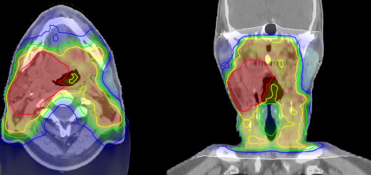 microRNAs predict recurrence risk of head and neck tumors