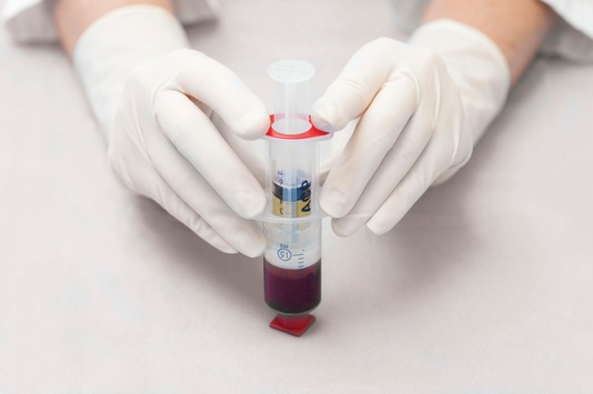 Bioregenerative Therapie von Arthrosen und Sportverletzungen - Mit ACP aus dem eigenen Blut direkt in Gelenke, Muskeln oder Sehnen