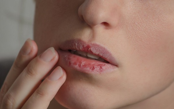 Gereizte Lippen im Winter: Ursachen, Behandlung, Risiken